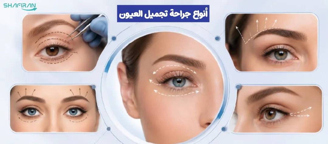 جراحات العين التجميلية في إيران