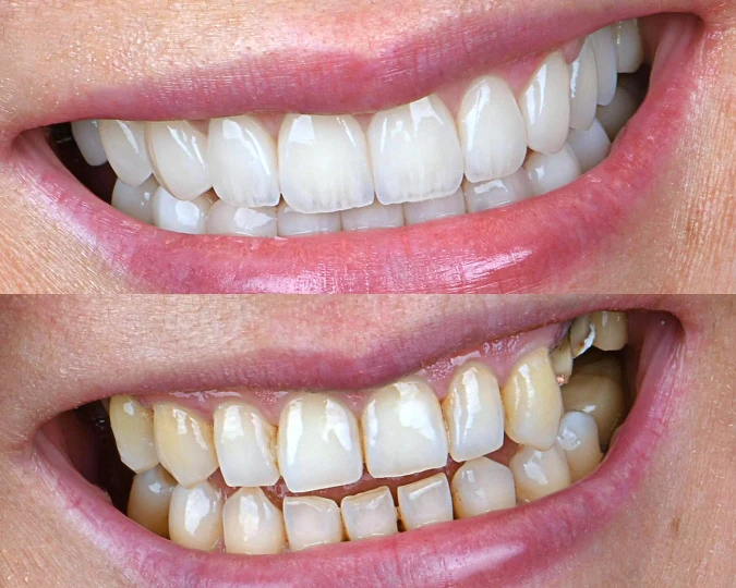 نموونە کاری کامپۆزیتی ددان