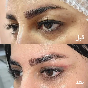 نمونەی پێش و پاش بلافرۆپلاستی
