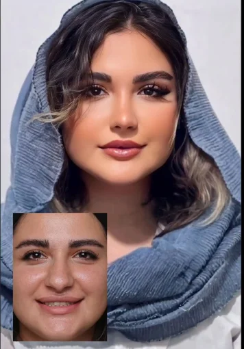نمونەی پێش و پاش نەشتەرگەری جوانکاری