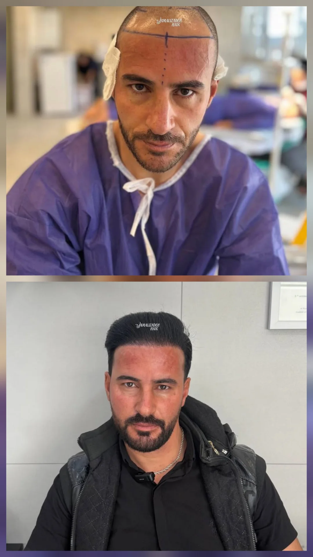 نمونەی پێش و پاش نەشتەرگەری جوانکاری