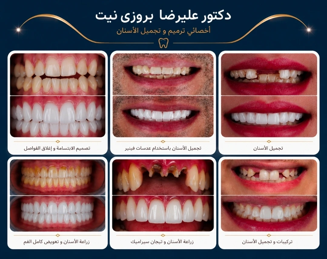 حالة قبل وبعد من أعمال دكتور علیرضا بروزي نيت في طب الأسنان