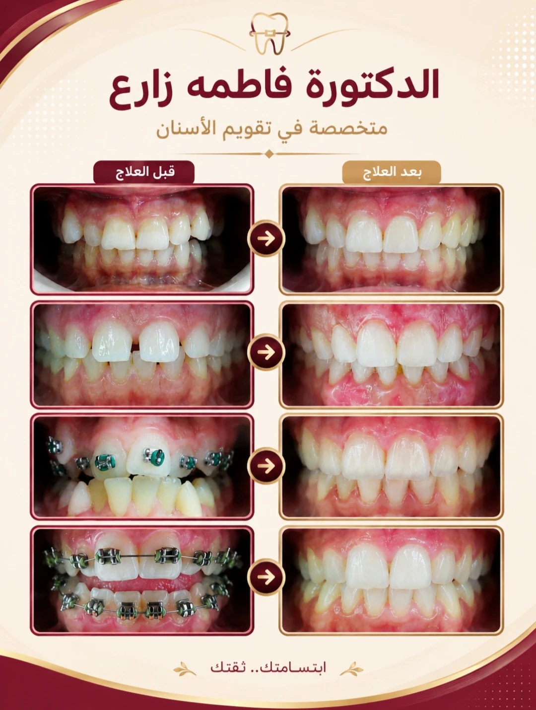 حالة قبل وبعد تقويم الأسنان من دكتورة فاطمة زارع