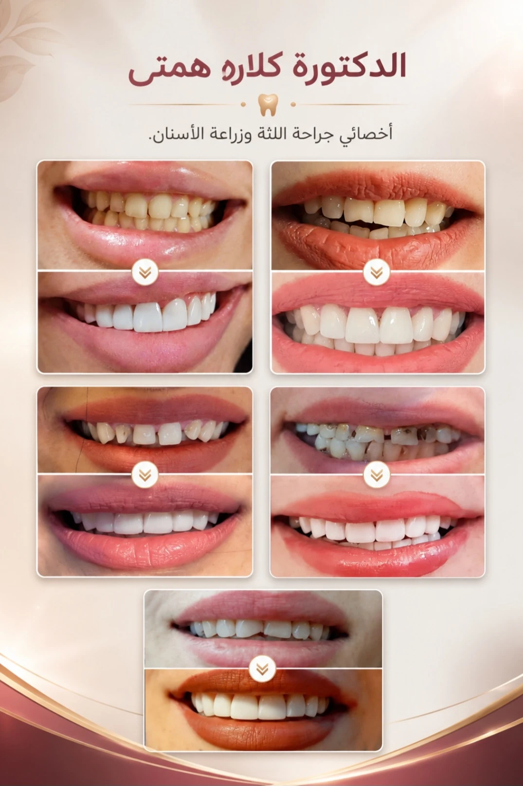 حالة قبل وبعد من أعمال دكتورة كلاره همتي