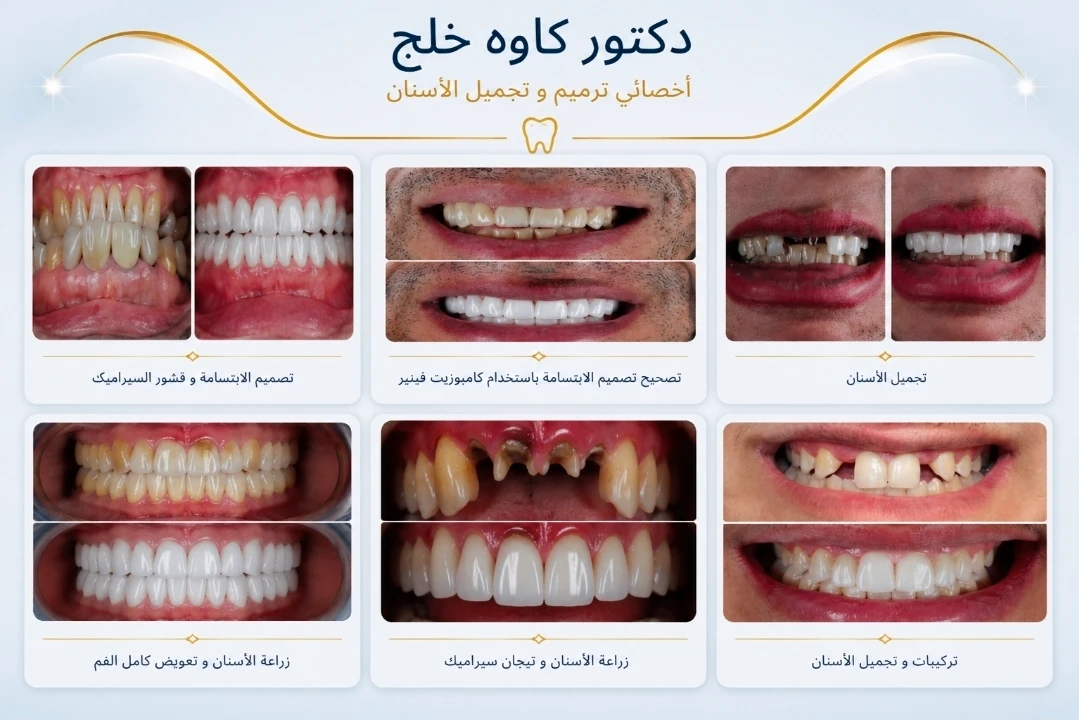 حالة قبل وبعد من أعمال دكتور كاوه خلج في تجميل الأسنان