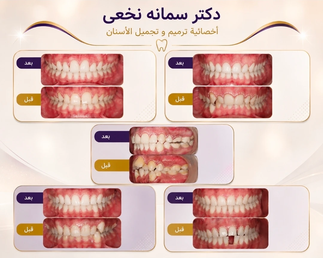 حالة قبل وبعد تقويم الأسنان من دكتورة سمانه نخعي