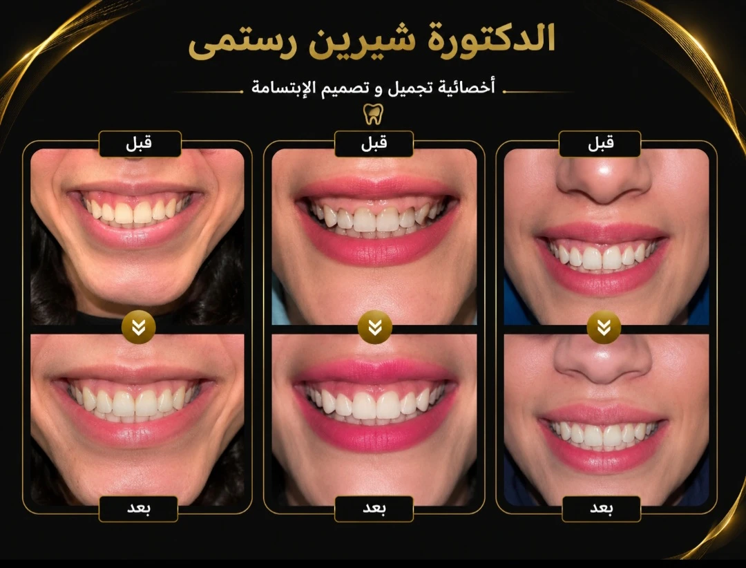 حالة قبل وبعد من أعمال دكتورة شيرين رستمي في ترميم الأسنان