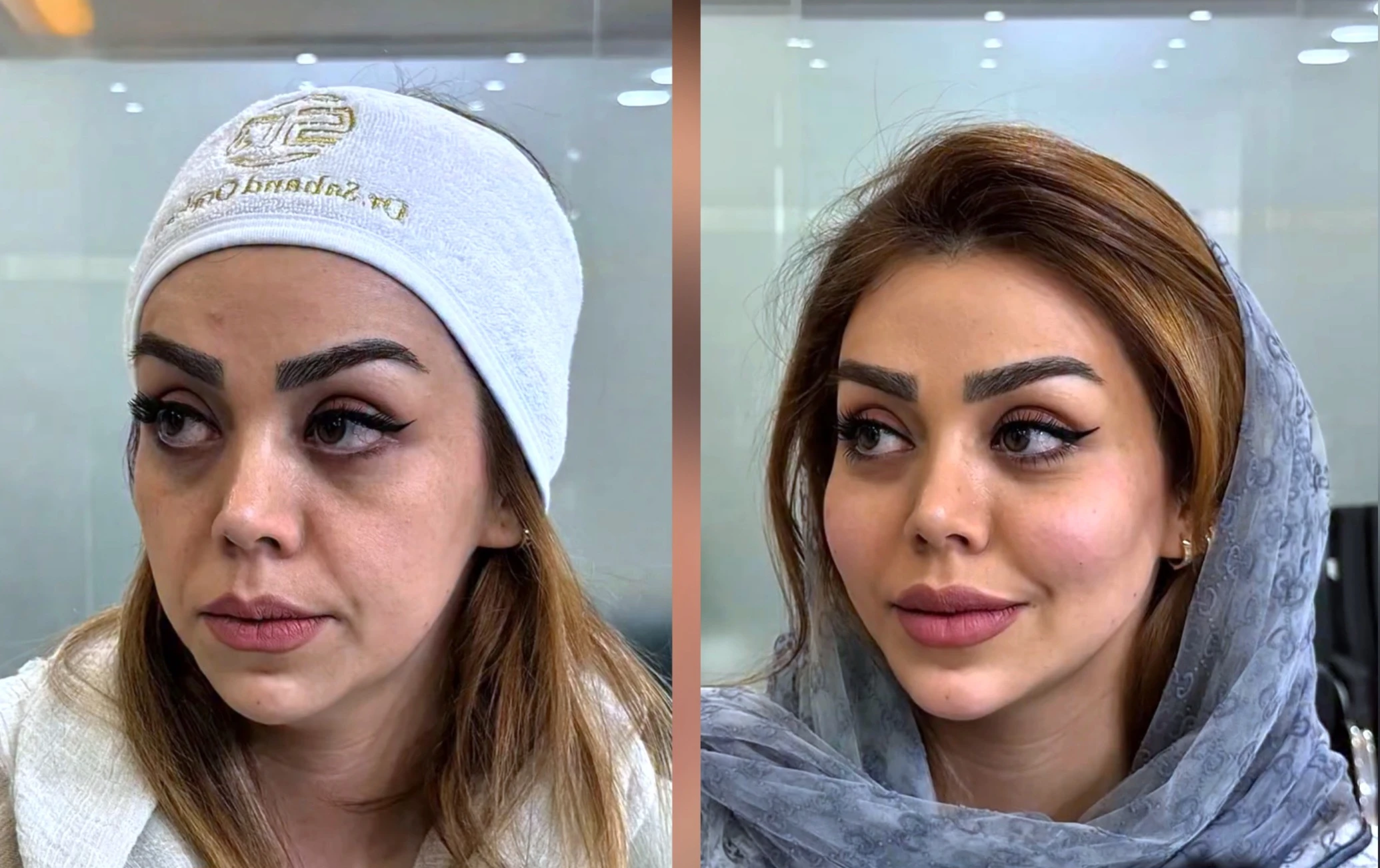 قبل وبعد عملية تجميل الوجه