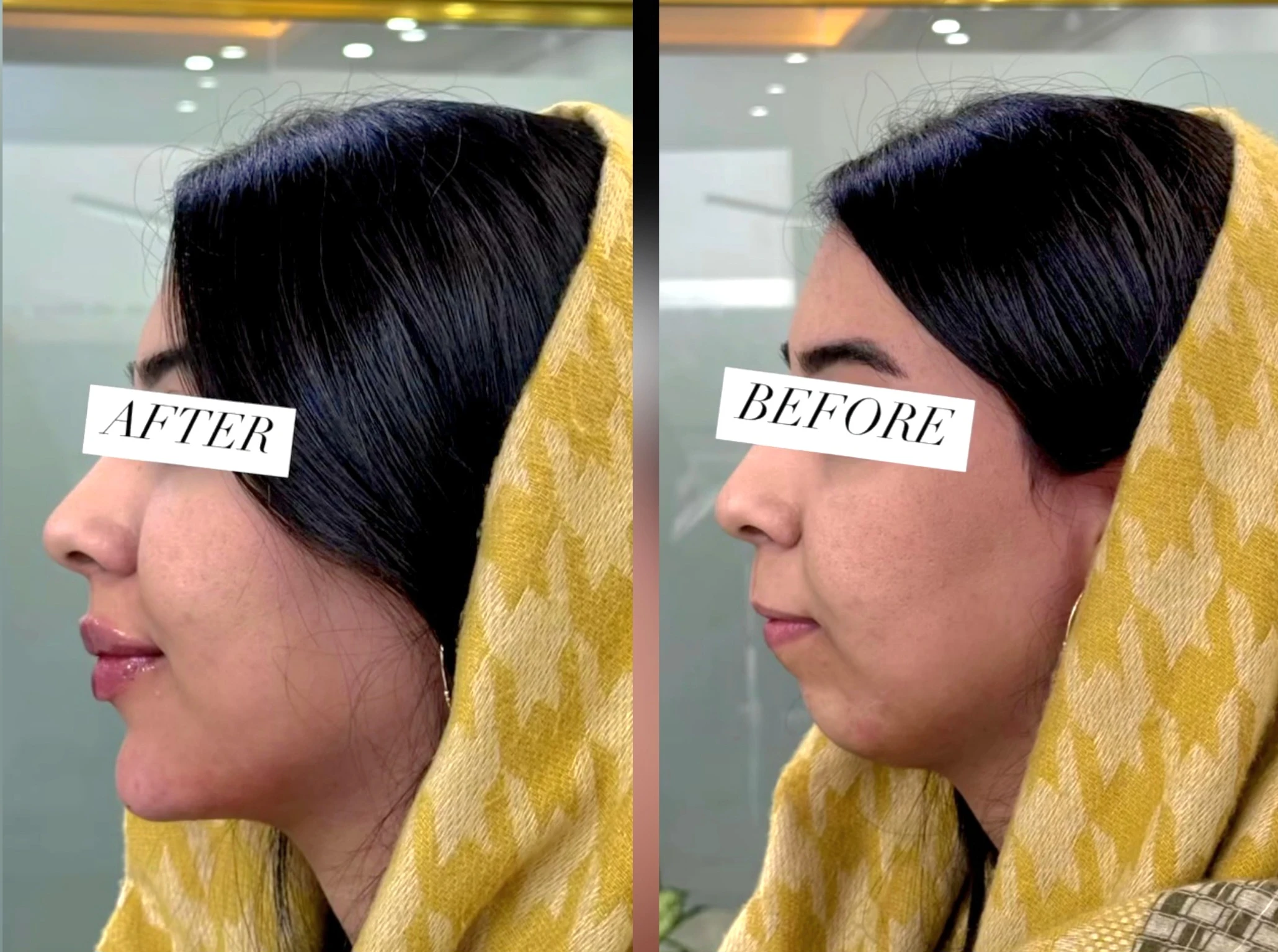 نتيجة جراحة تجميل الوجه