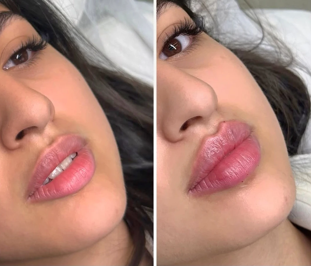 تجميل الوجه بحقن الفيلر