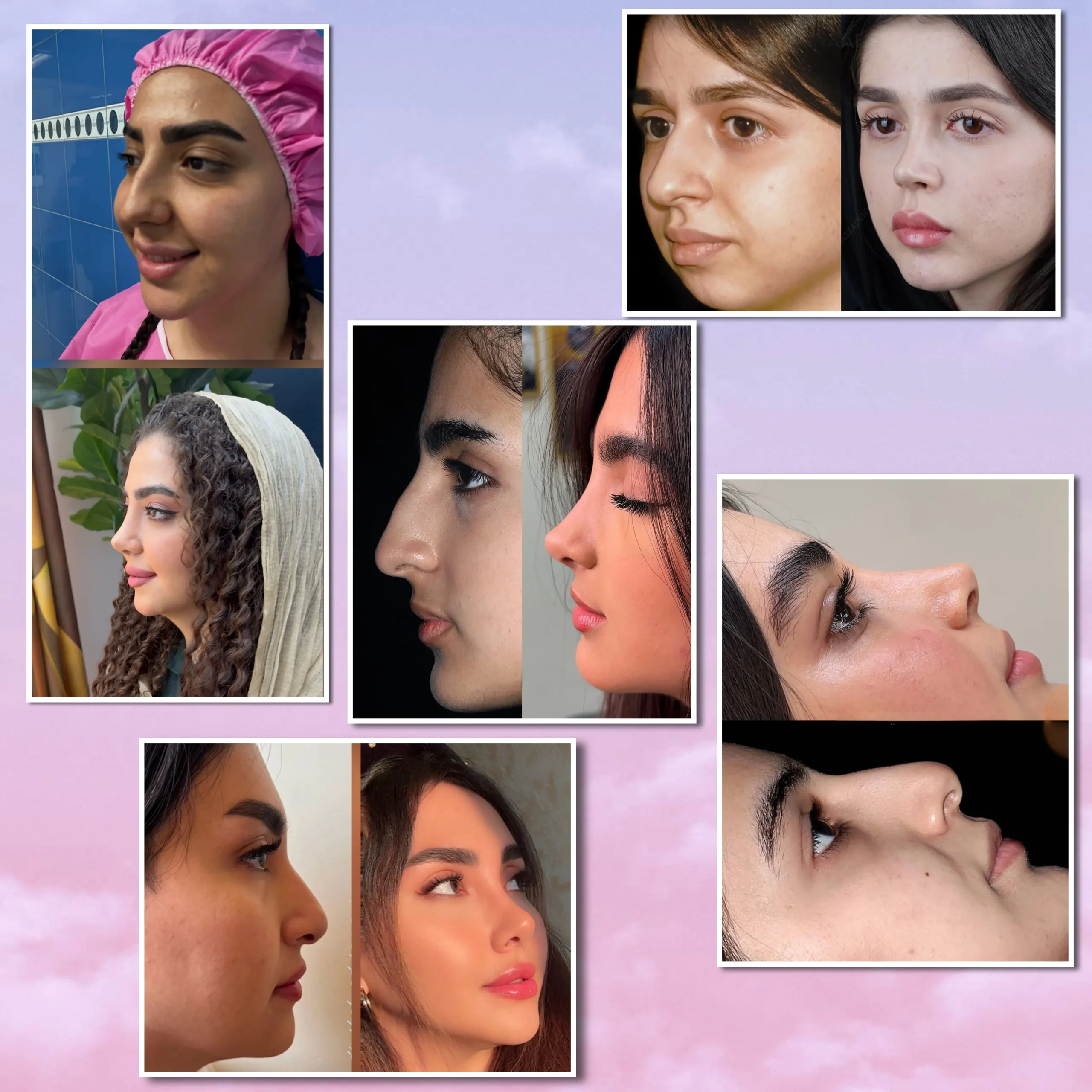عملية تجميل الأنف