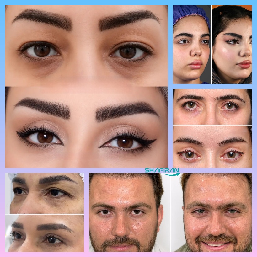 صور قبل وبعد عمليات تجميل العيون