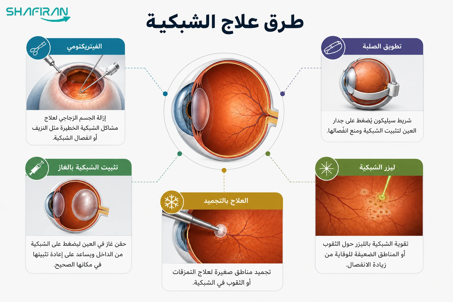 أنواع عمليات الشبكية